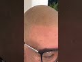 Soft and natural scalp micropigmentation hairline #scalpmicropigmentation #hair  #hairlosssolution