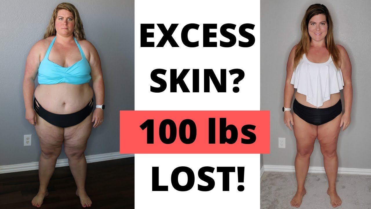 Week 48 Keto Transformation │Excess Skin After 100 Pound Loss? YouTube