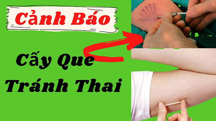 Cấy que tránh thai có bị mất kinh nguyệt không