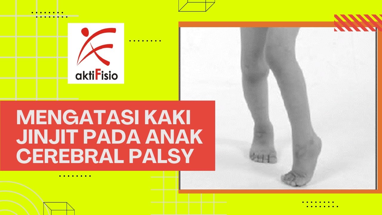 Mengatasi Kaki Jinjit Pada Anak Cerebral Palsy