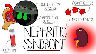 Understanding Nephritic Syndrome (With Pathology Made Easy)