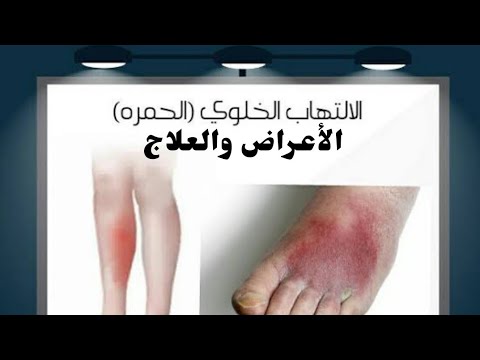 إلتهاب النسيج الخلوى ومرض الحمرة