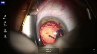 OD 2026 02 04 122218  Phaco Puresee