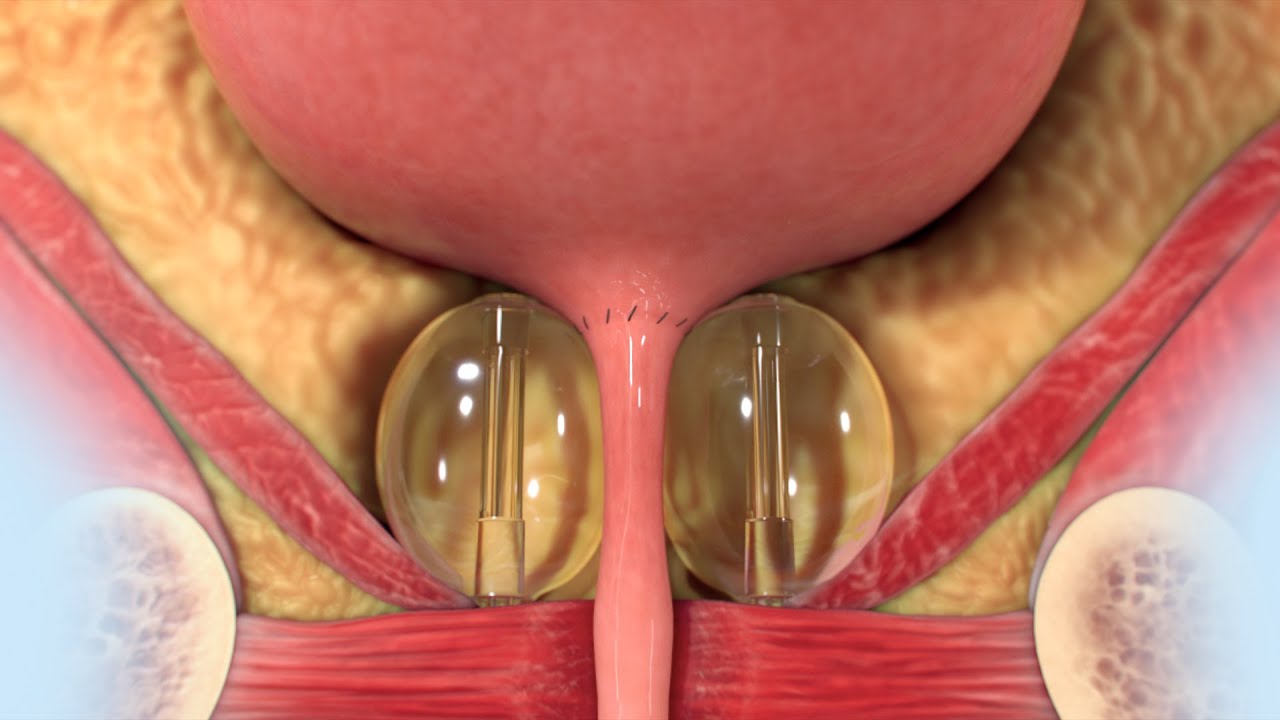 Proact Prostate ProACT Animation for Patients - YouTube