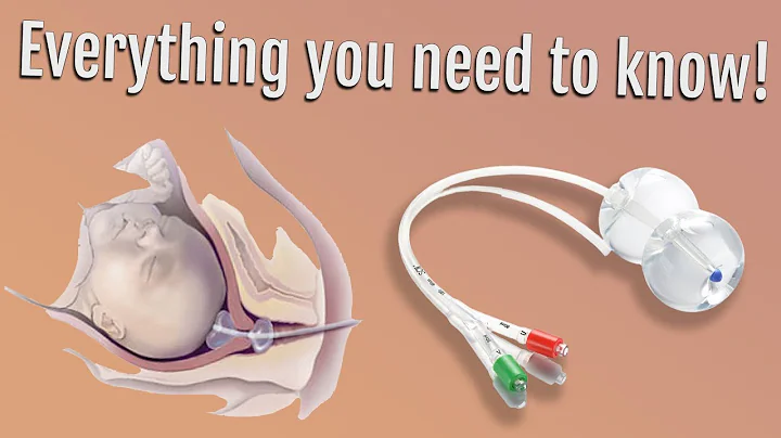 What is a Cervical Balloon?