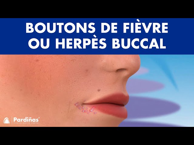 boutons-de-fi-vre-sur-la-langue-bouton-dans-la-bouche-aphte-ou