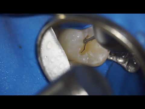 Видео: Препарирование зуба под микроскопом