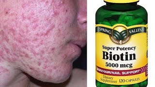 Biotin! BAD Breakouts & Side Effects