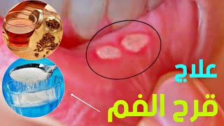 أسباب وعلاج قرح الفم - mouth ulcers
