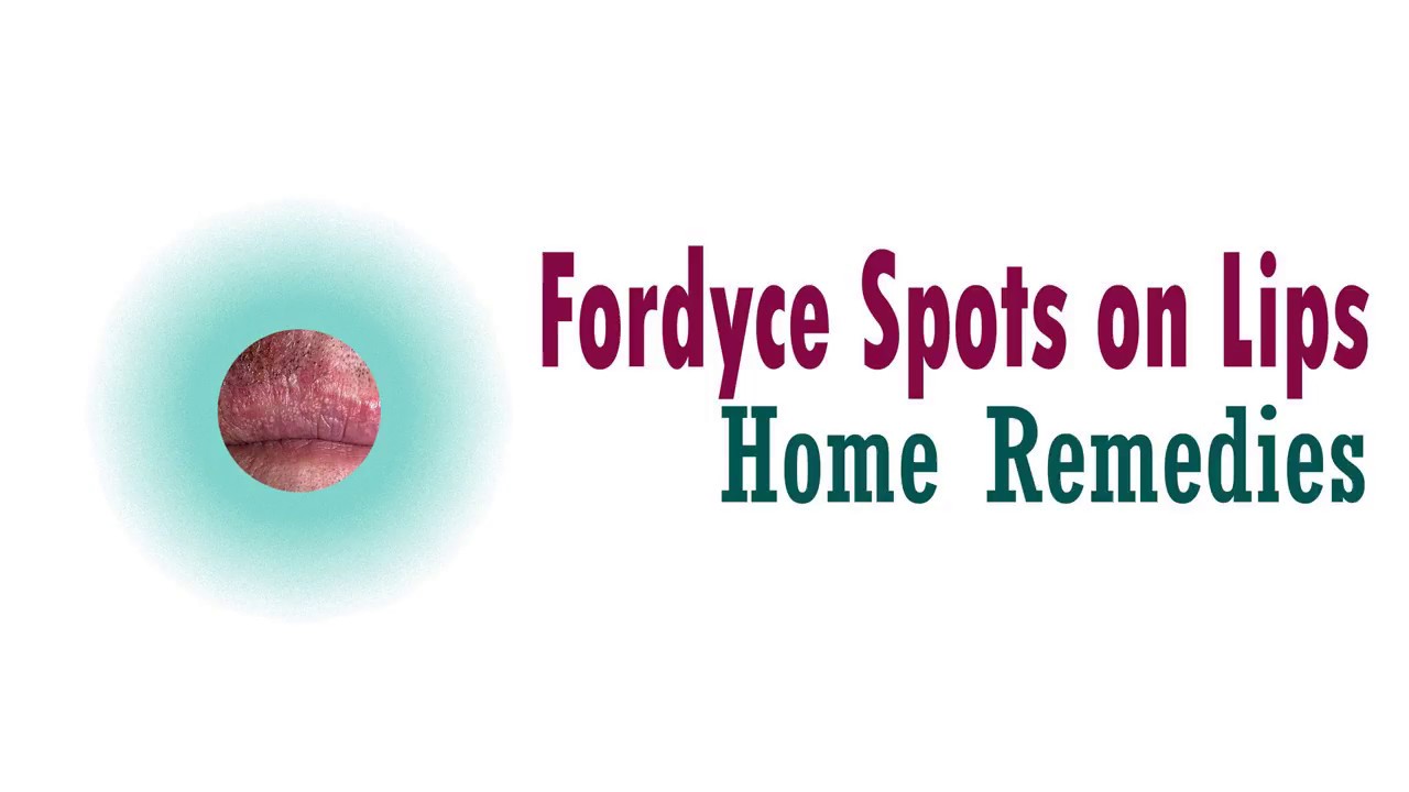 Fordyce Spots on Lips Home Remedies YouTube