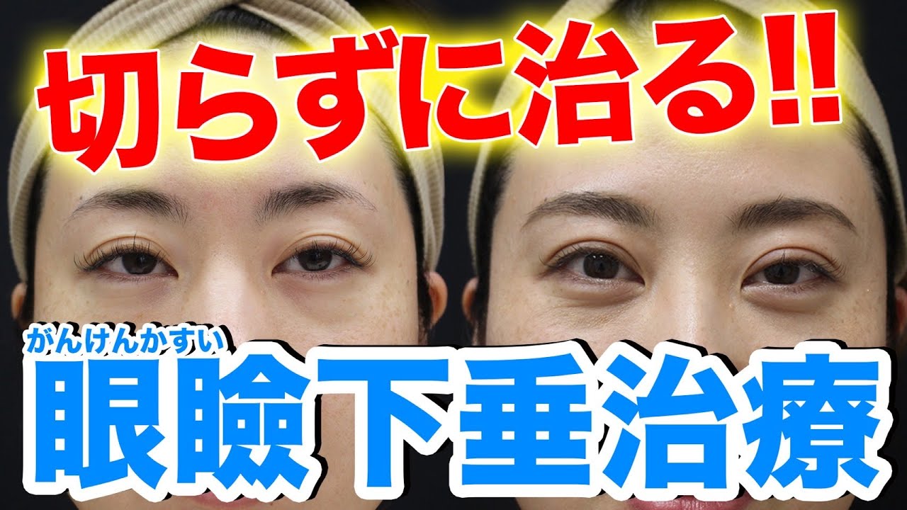 まぶた 脂肪 取り 自力