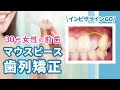 自然で目立たない!!マウスピースを使った歯列矯正 How I Straighten My Teeth With A Mouthpiece