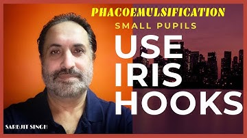 Using Iris Hooks in Small Pupils | Phacoemulsification | Cataract
