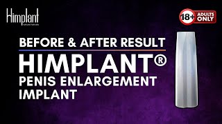 Before & After Penis Enlargement Procedure | HIMPLANT® Cosmetic Male Enhancement Implant (Explicit)