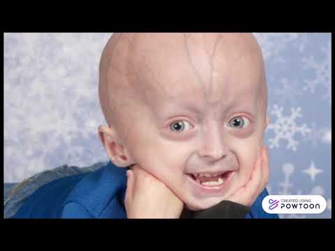 Vídeo: O Menino Britânico Tornou-se Outra Vítima Da Misteriosa Progeria - Visão Alternativa