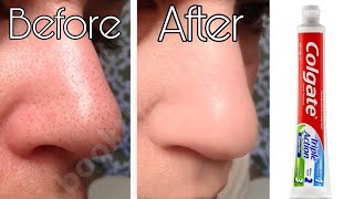 How to remove blackheads & whiteheads from nose & face || Mahe’s technique