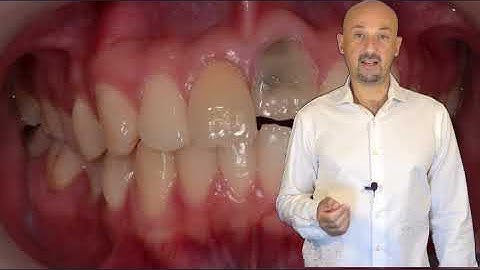 Implants in the Aesthetic Zone: A Challenging case!