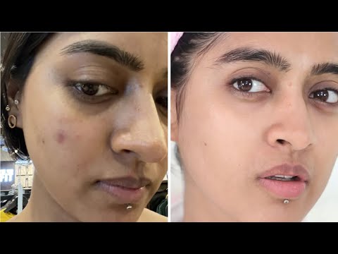 Get rid of Hyperpigmentation, Melasma and Acne marks with this routine