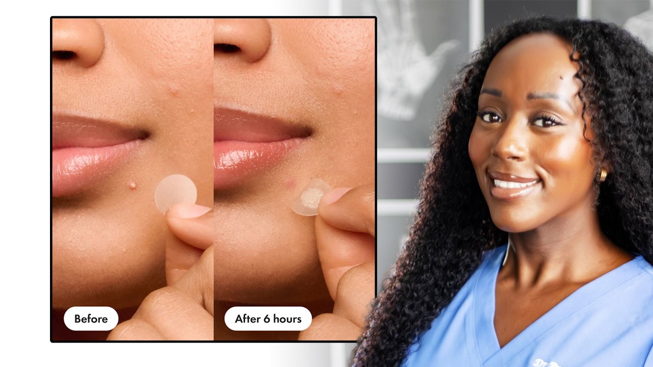 Do Pimple Patches Really Work!? How to Get Rid of Acne Fast