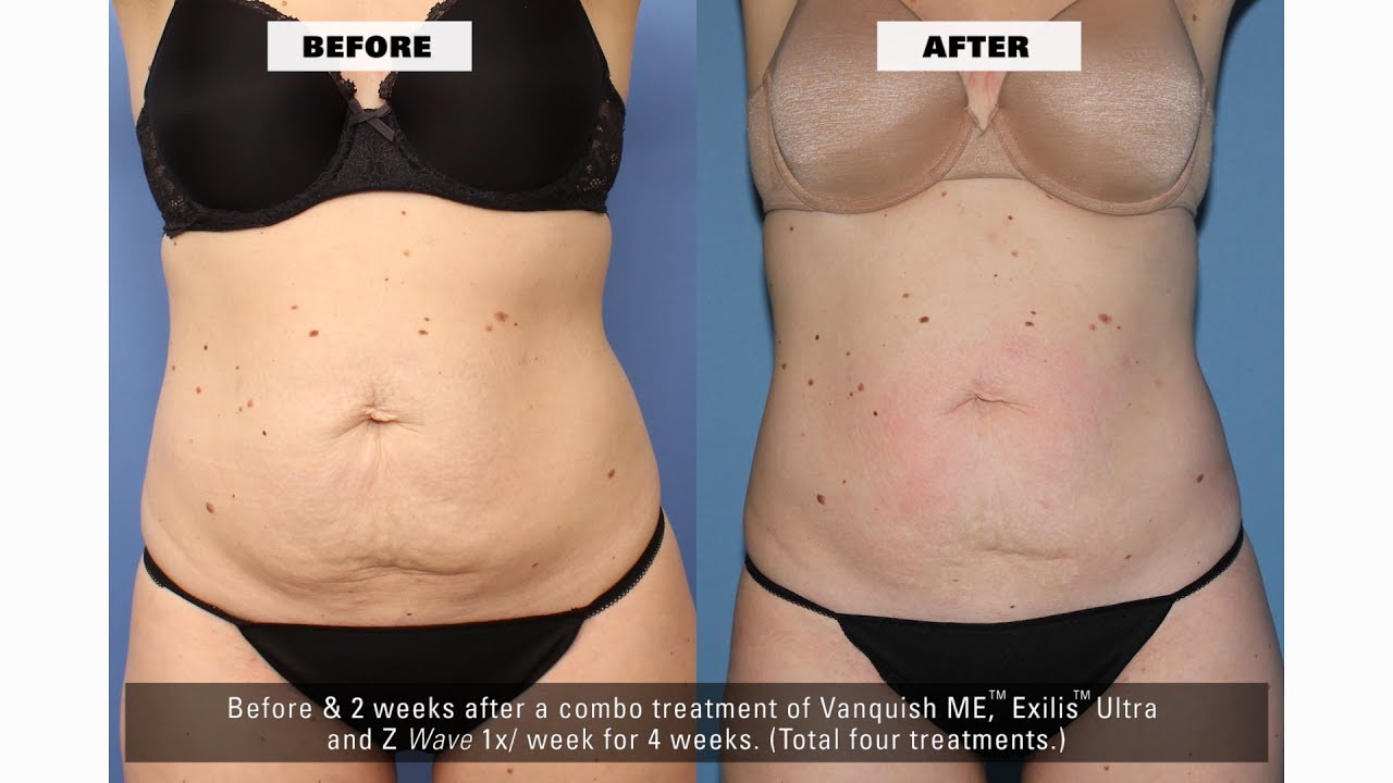 Non-Surgical Fat Removal Review - Vanquish Liposuction Results