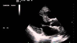 Cardiac Amyloidosis PLAX view.avi