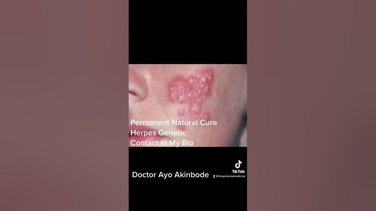 permanent-natural-cure-for-herpes-genetic-and-other-diseases-virus