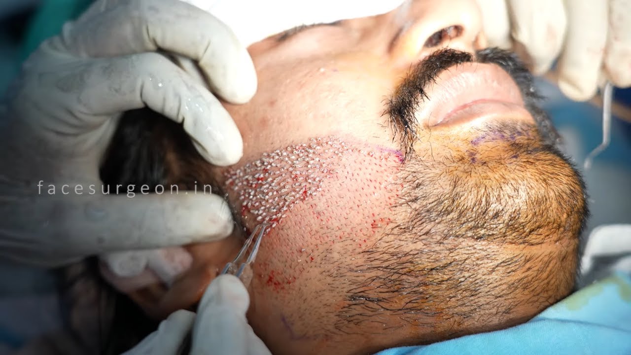 Beard Transplant Surgery Before And After - Beard Transplant 5 Month Amazing Result