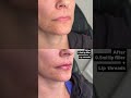 #LipLines#LipstickBleeding#PerioralLines#PDOLipThreads#LipBorderSupport