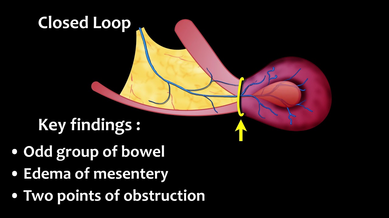 How to diagnose Bowel Ischemia part 2 YouTube