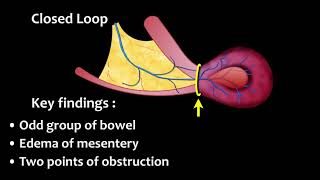 How to diagnose Bowel Ischemia - part 2