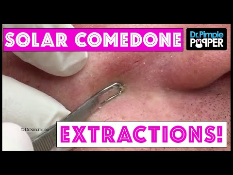 Great BLACKHEAD Extractions!!