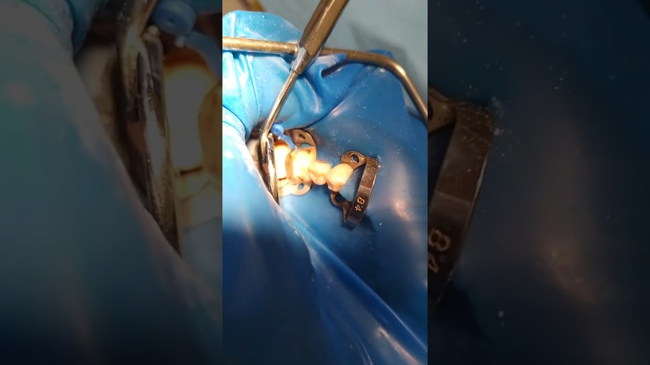 Isolation 37-34 teeth.