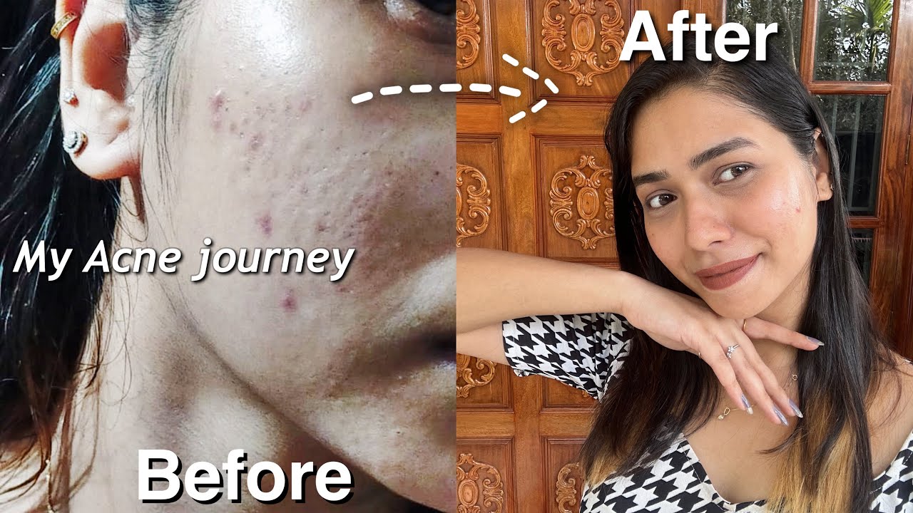 How I Got Rid of My Acne *3 products that changed my life |ഈസി removal ...