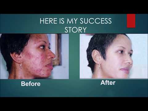 Acne Treatment: Best Natural acne Cure - How to Stop Pimples