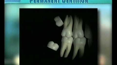 Clip 20: Eruption of Third Molars