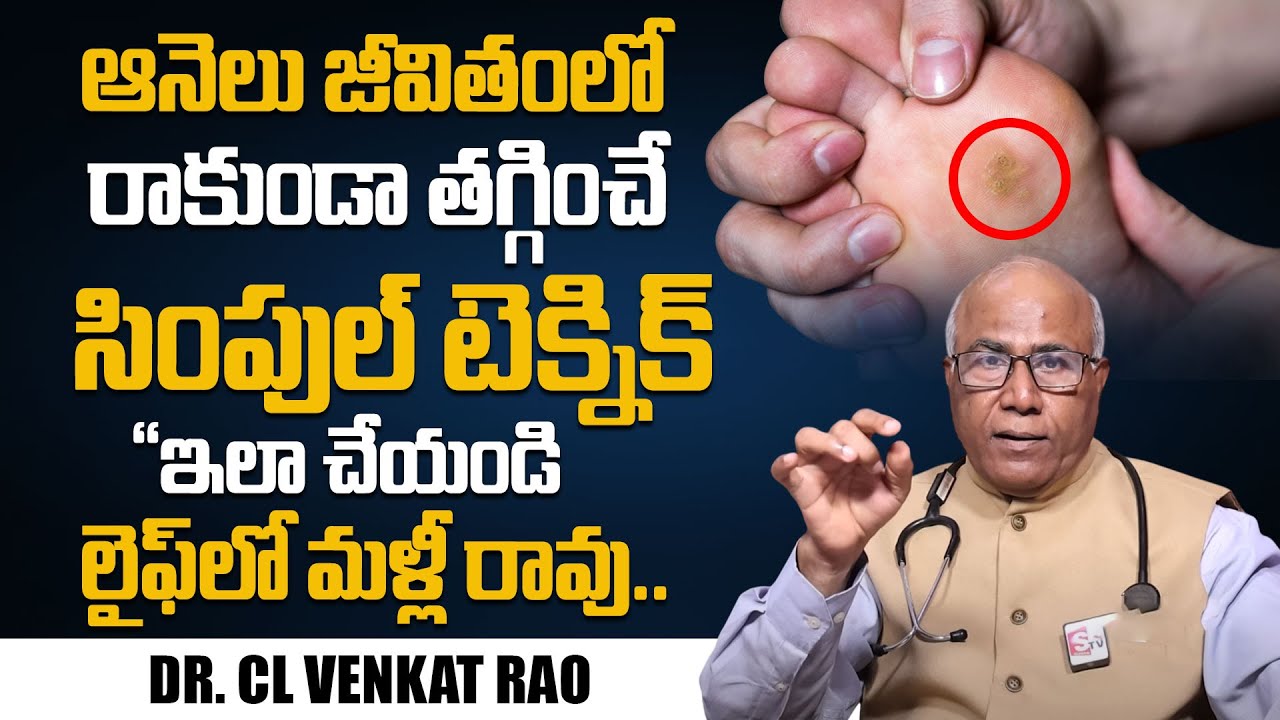 ఇలా చేస్తే ఆనెలు దెబ్బకి మటుమాయం | Corns | How to Removal Foot Corn? | Dr CL Venkat Rao | SumanTV