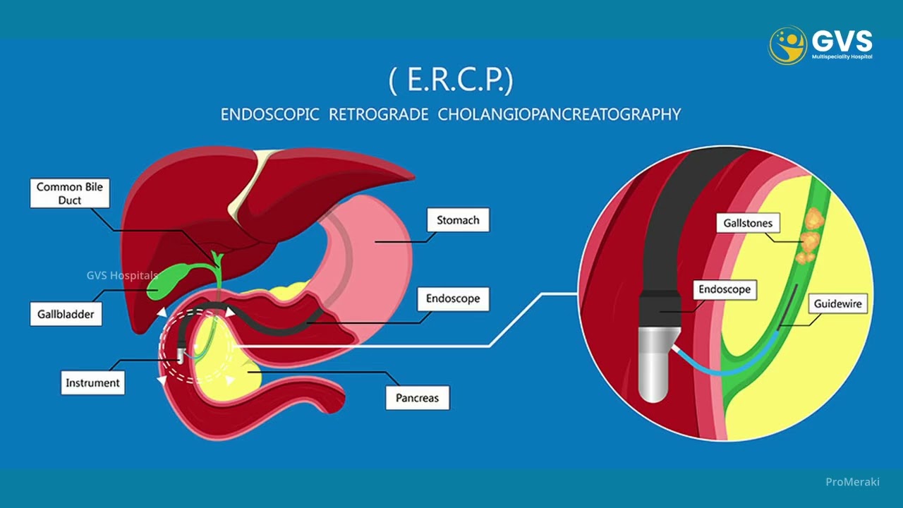 What Is Biliary Pancreatitis? | Causes & Symptoms | Dr Ram Gopal Teja
