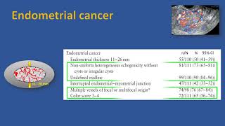 International Endometrial Tumor Analysis (IETA) terminology #UOGJournal video abstract