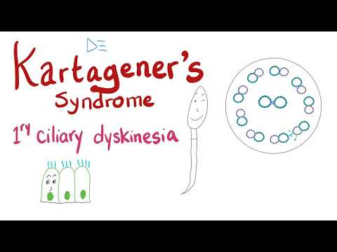 Kartagener&rsquo;s Syndrome (Immotile Cilia Syndrome or Primary Ciliary Dyskinesia) | Pulmonology