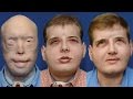 Firefighter's face transplant is making medical history