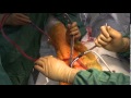 Direct Anterior Hip Replacement by William Kurtz MD