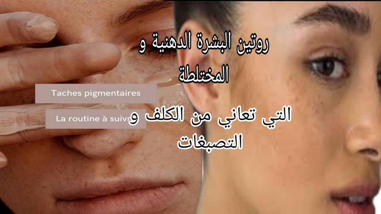 روتين البشرة الدهنية و المختلطة التي تعاني من الكلف و التصبغات/عصارة تجربتي و كيف قضيت على الكلف