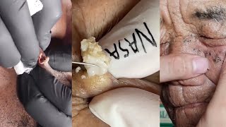 27 Minutes Of Top ASMR Pimple Popping Video