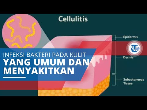 Selulitis (Cellulitis), Infeksi Bakteri Kulit yang Umum, Menyakitkan, dan Timbulkan Warna Kemerahan