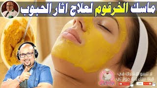 ماسك الخرقوم البلدي والعسل لعلاج أثار الحبوب مع الدكتور عماد ميزاب imad mizab