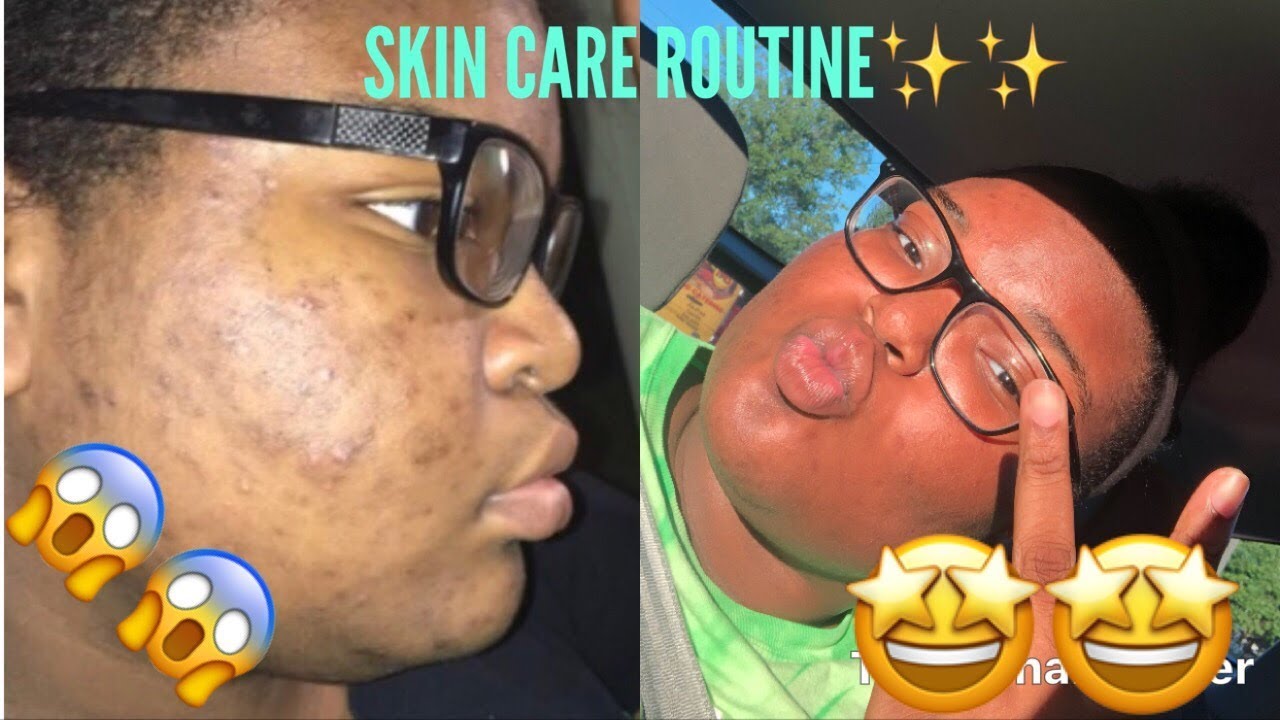 HOW I GOT RID OF MY ACNE AND DARK SPOTS IN A MONTH!!! | SKIN CARE ...