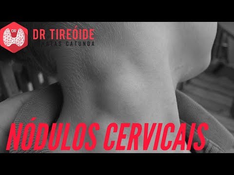 Vídeo: Cisto Cervical: Sintomas, Tratamento, Diagnóstico, Foto