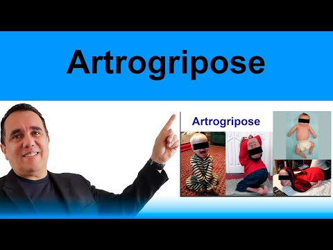 Vídeo: A artrogripose pode ser curada?