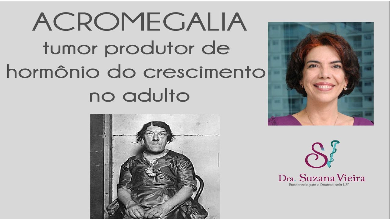 Acromegalia - excesso de hormnio de crescimen to no adulto - YouTube