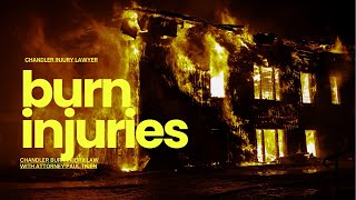 Burn Injuries in Arizona | Chandler Personal Injury Lawyer Paul Ticen Explains